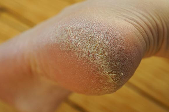 Razpoke na peti